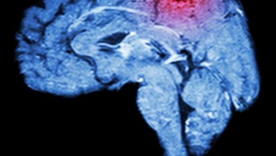 ¿Qué son los miniderrames cerebrales y cómo nos damos cuenta de ellos?