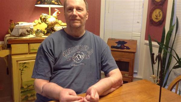 Hombre que recibió primer trasplante de manos pide que se las quiten