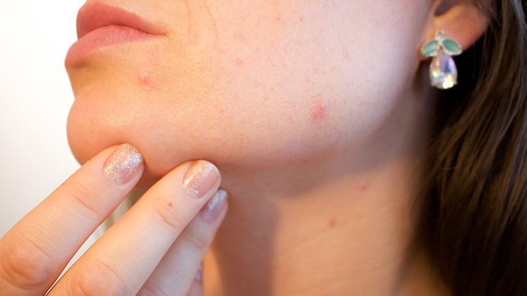 El acné podría tener una ventaja sorprendente para los que lo sufren
