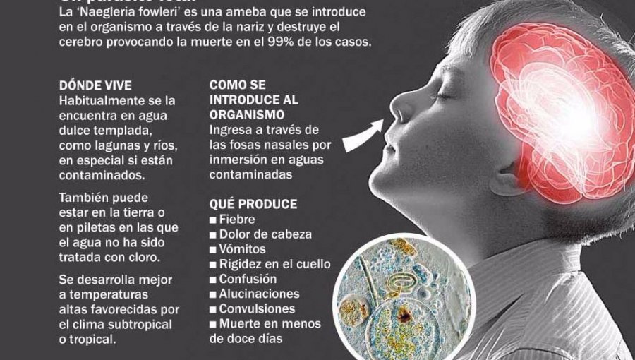 Investigan presencia de temida ameba "come-cerebros" en niño de Coquimbo que se mantiene grave en el Hospital
