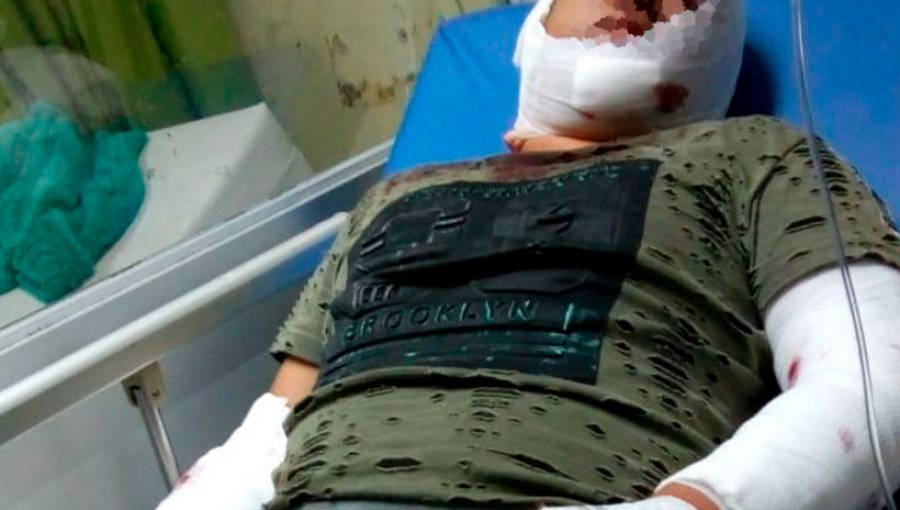 Niño de 12 años quedó con graves heridas tras brutal ataque de un perro Akita en Quilpué