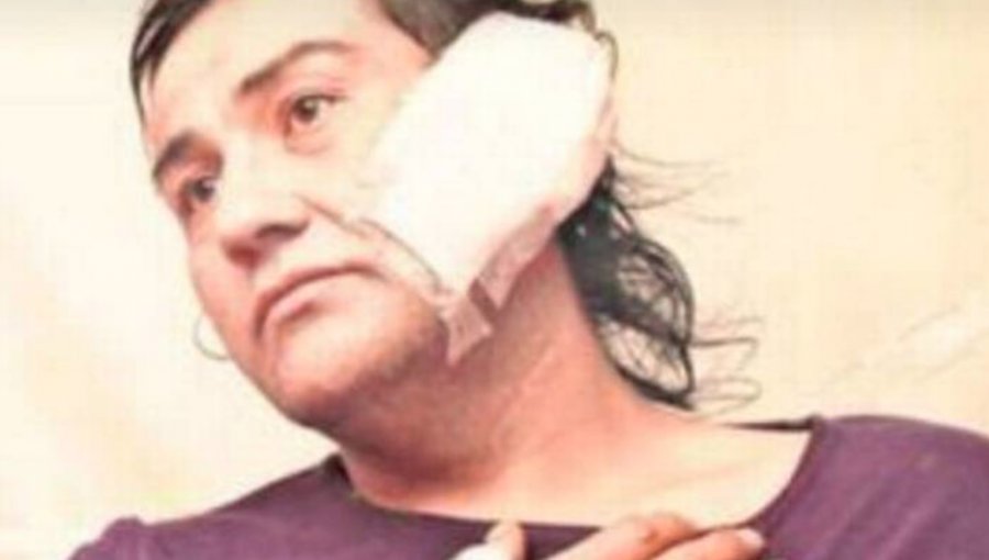 Mujer trans denunció brutal golpiza de camionero en Ñuble: la agredió con un machete