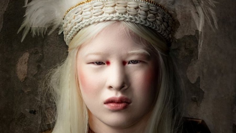 La historia de la bebé albina abandonada en China que se convirtió en modelo de Vogue